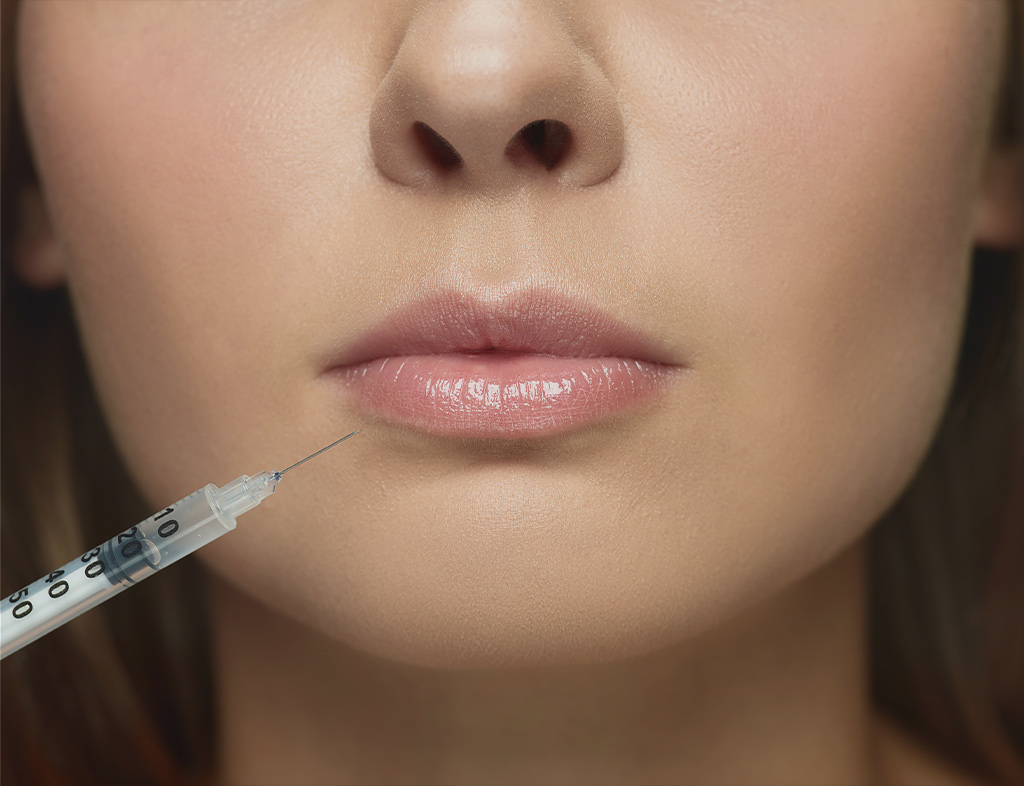 Full lips with enhanced contour and definition after lip filler treatment at Akasha Wellness & Spa.